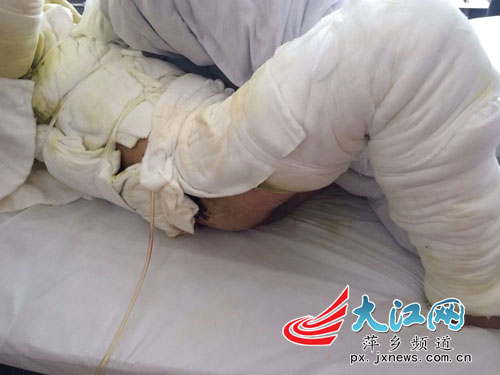 在萍乡市第二人民医院四楼烧伤科急诊室看到伤者周增辉全身被纱布包扎
